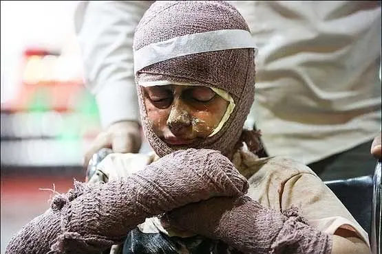 آشنایی با انواع سوختگی ناشی از حملات جنگی؛ برای کدام سوختگی به مراکز درمانی مراجعه کنیم؟