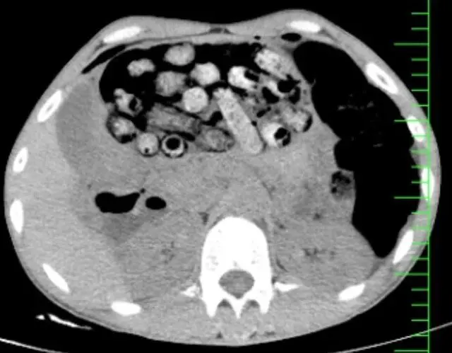 جراحي،بيمار،بسته،تصويربرداري،روده،معده،اورژانس