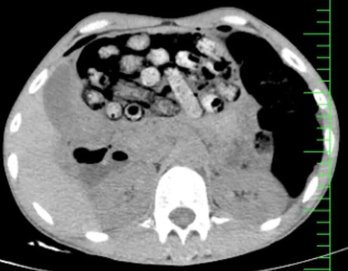 خروج ۹۰ بسته مواد مخدر از معده و روده یک بیمار در کرج طی عمل جراحی+ عکس 