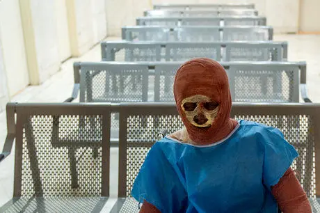 سوختگي،كشور،پوشش،وضعيت،نوين،بيمارستان،شيميايي،لباس،حوزه،گذشت ...