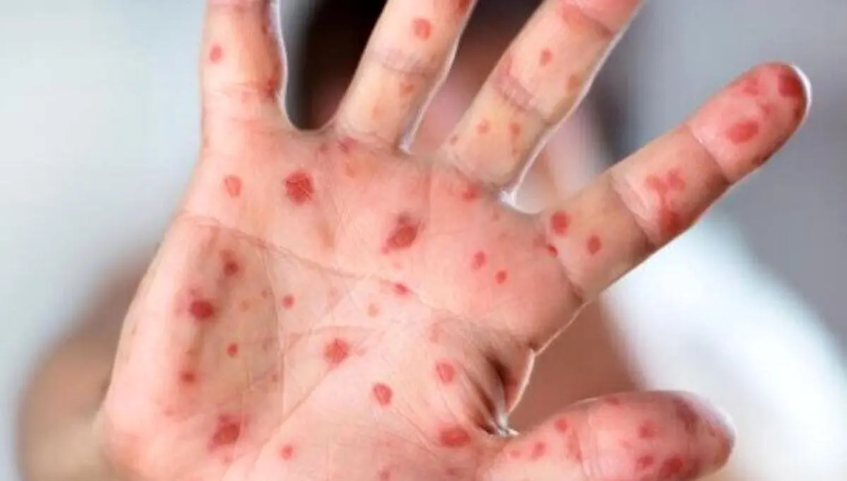 شیوع بیماری؛ سرخک ۲۹ نفر را در بابل روانه بیمارستان کرد