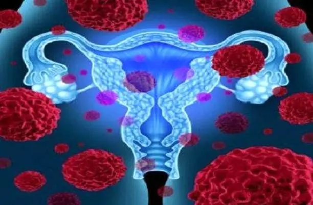 زنان؛ اگر این بیماری‌های ساده را دارید به سرطان تخمدان مشکوک شوید