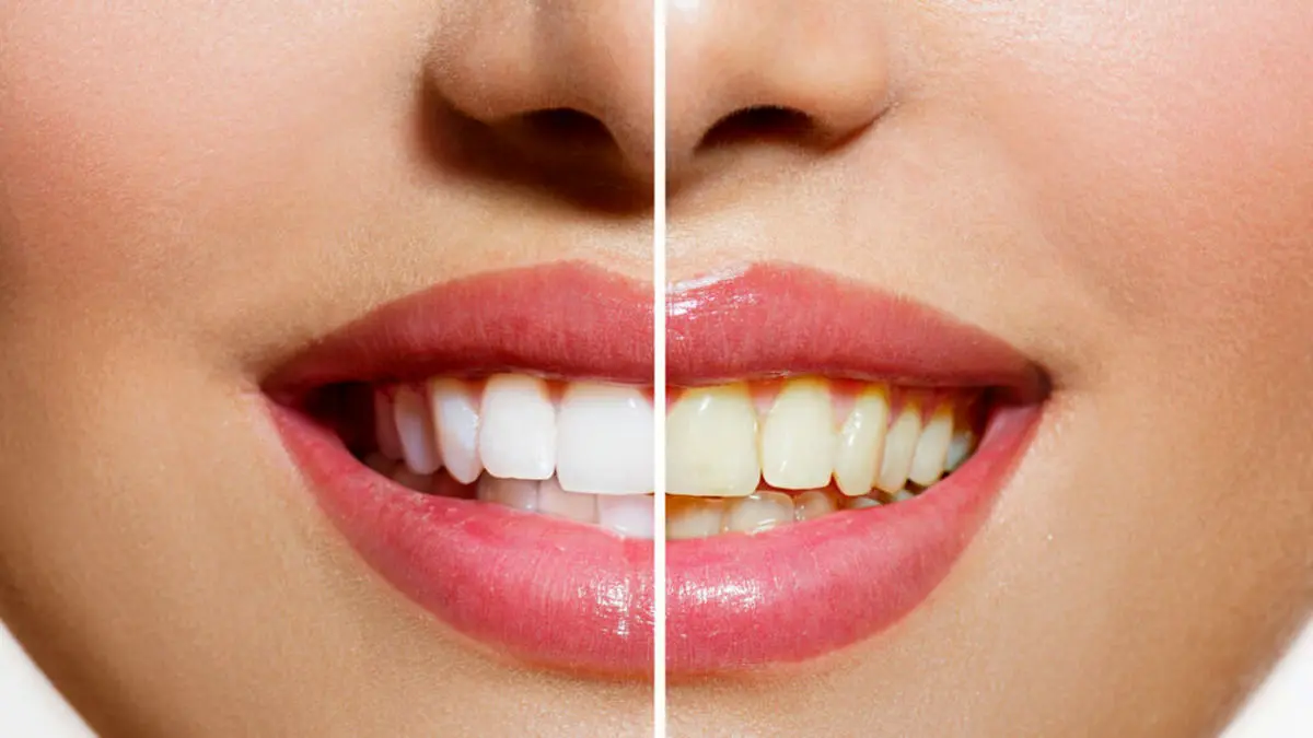 چرا دندان‌درد اینقدر آزاردهنده و درد آن مشهور است + تصویر