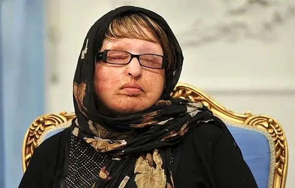 ديه،اسيدپاشي،آمنه،مجيد،قرباني،قضايي،اجراي،تهران،اسيدپاش،دادسراي