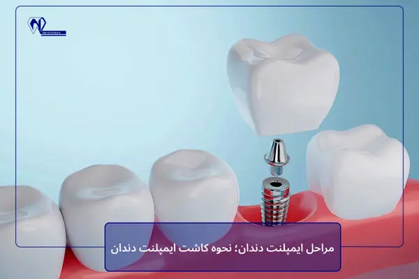 مراحل ایمپلنت دندان؛ نحوه کاشت ایمپلنت دندان
