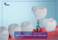 مراحل ایمپلنت دندان؛ نحوه کاشت ایمپلنت دندان
