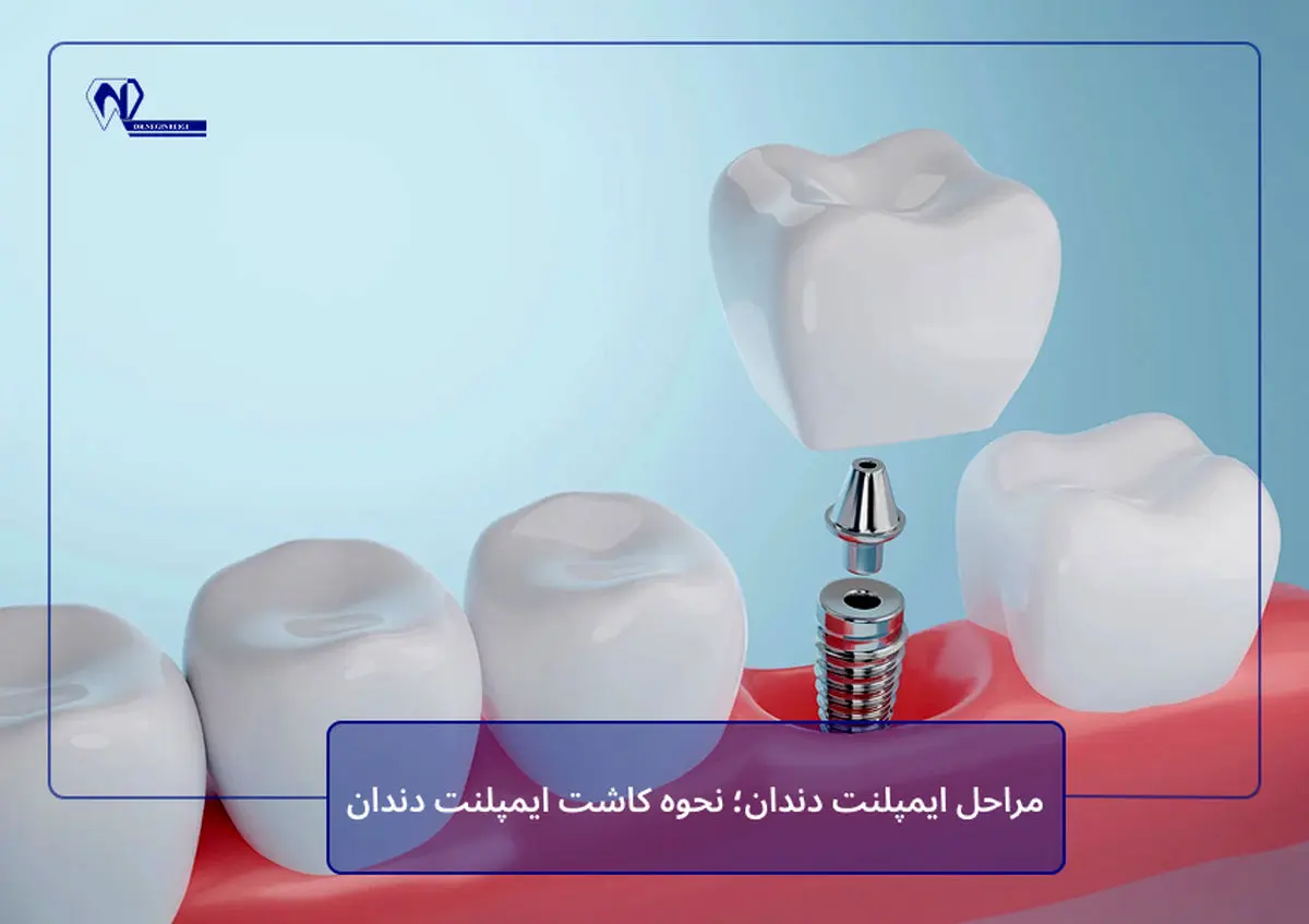 مراحل ایمپلنت دندان؛ نحوه کاشت ایمپلنت دندان
