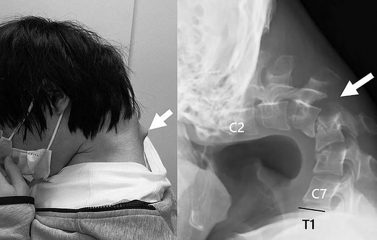 سندرم سر افتاده: جوان ژاپنی به خاطر موبایل دیگر قادر به بلند کردن سر نیست