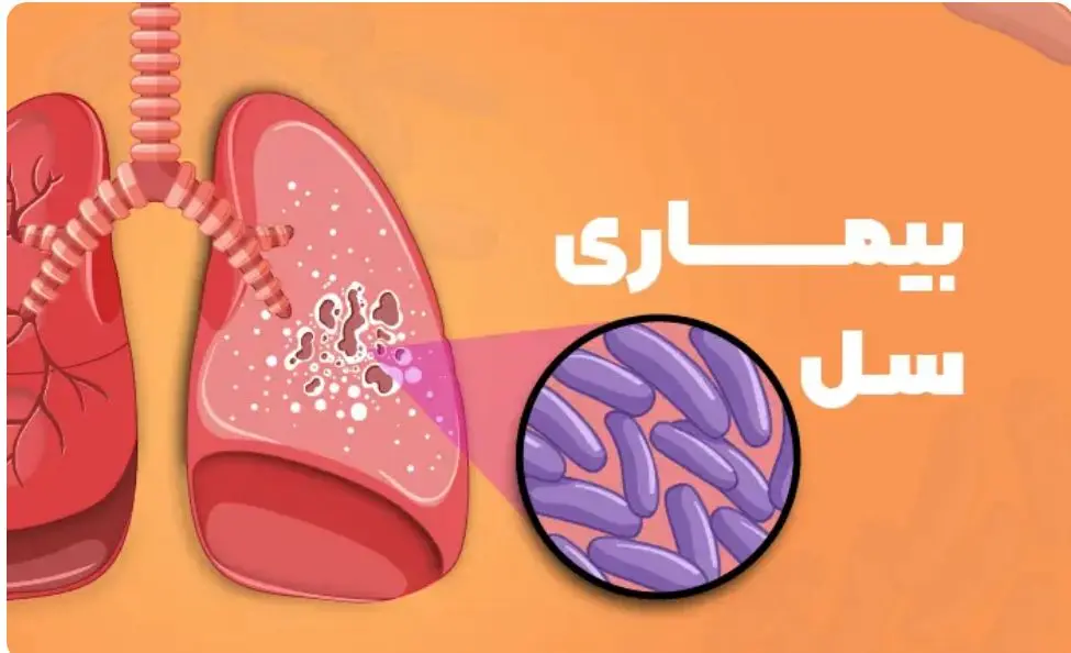 سل،بيماري،كشور،درمان،ابتلا،بهداشت،رايگان،پيشگيري،تخصصي،مديري ...