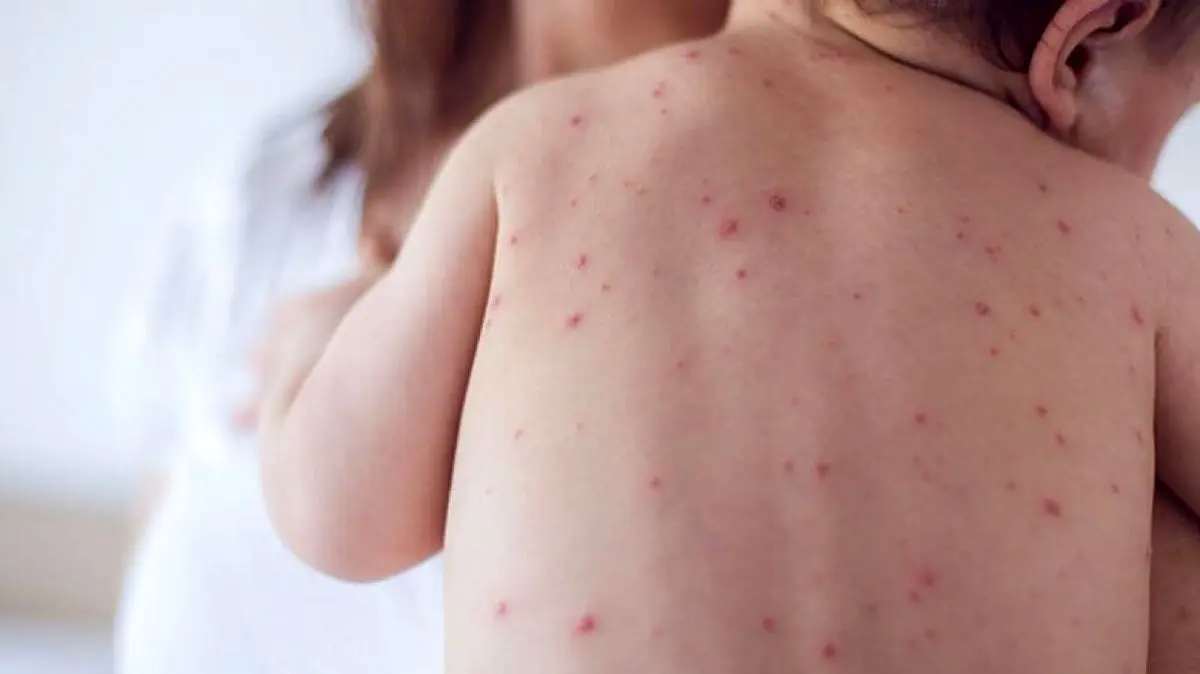 علائم «سرخک» و اهمیت واکسیناسیون کودکان در موعد مقرر