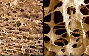 50 درصد سالمندان پوکی استخوان دارند؛ 4 عامل مهم پوکی استخوان چیست؟