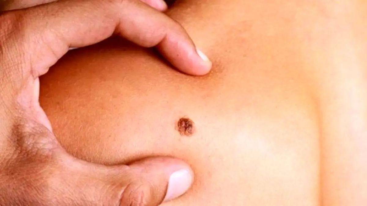 هیچ ارتباطی میان برداشتن خال و سرطان پوست وجود ندارد