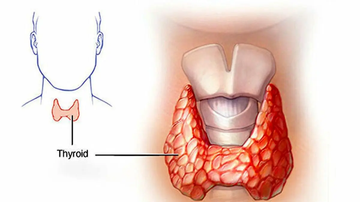 عوارض ناشی از کمبود ید و کارکرد تیروئید