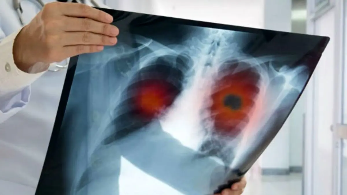 هیبرید ایمیجینگ در درمان سرطان مهم است