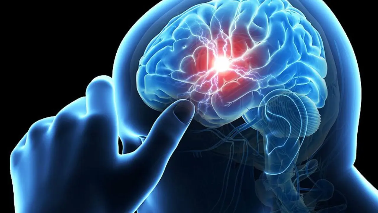 30 هزار بیمار سکته مغزی کشور درمان شدند