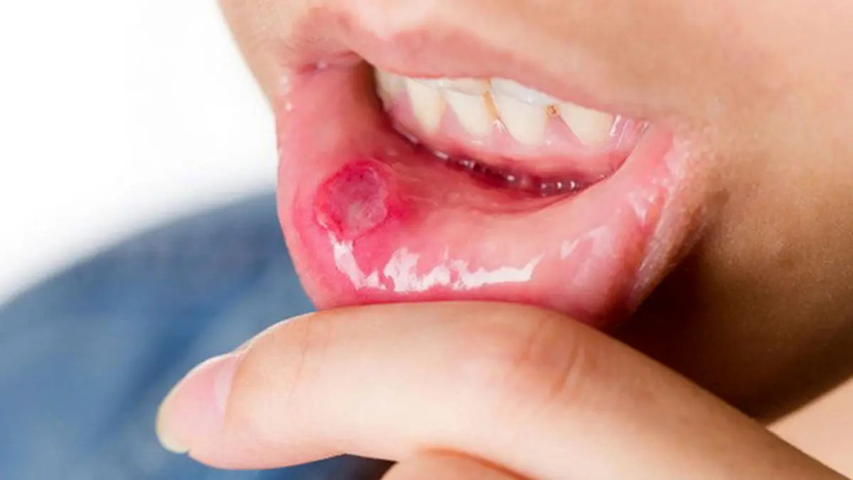 علائم سرطان دهان را بشناسید