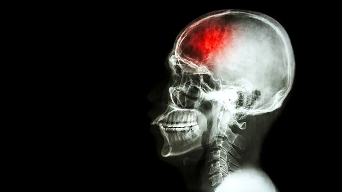 درمان آسیب‌های مغزی با کمک سلول‌های بنیادی