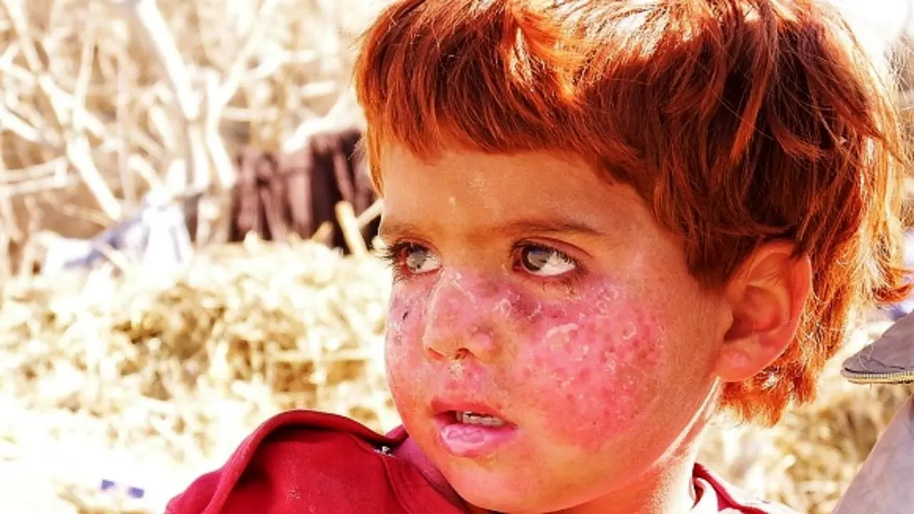 بیماری پوستی کودکان روستاهای خراسان جنوبی چیست؟