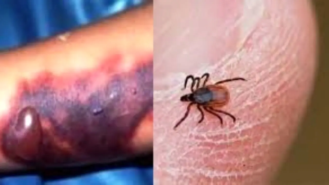 درمان بیمار مبتلا به تب کریمه کنگو در خوزستان