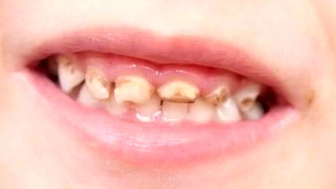 300 میلیون دندان پوسیده در دهان ایرانیان