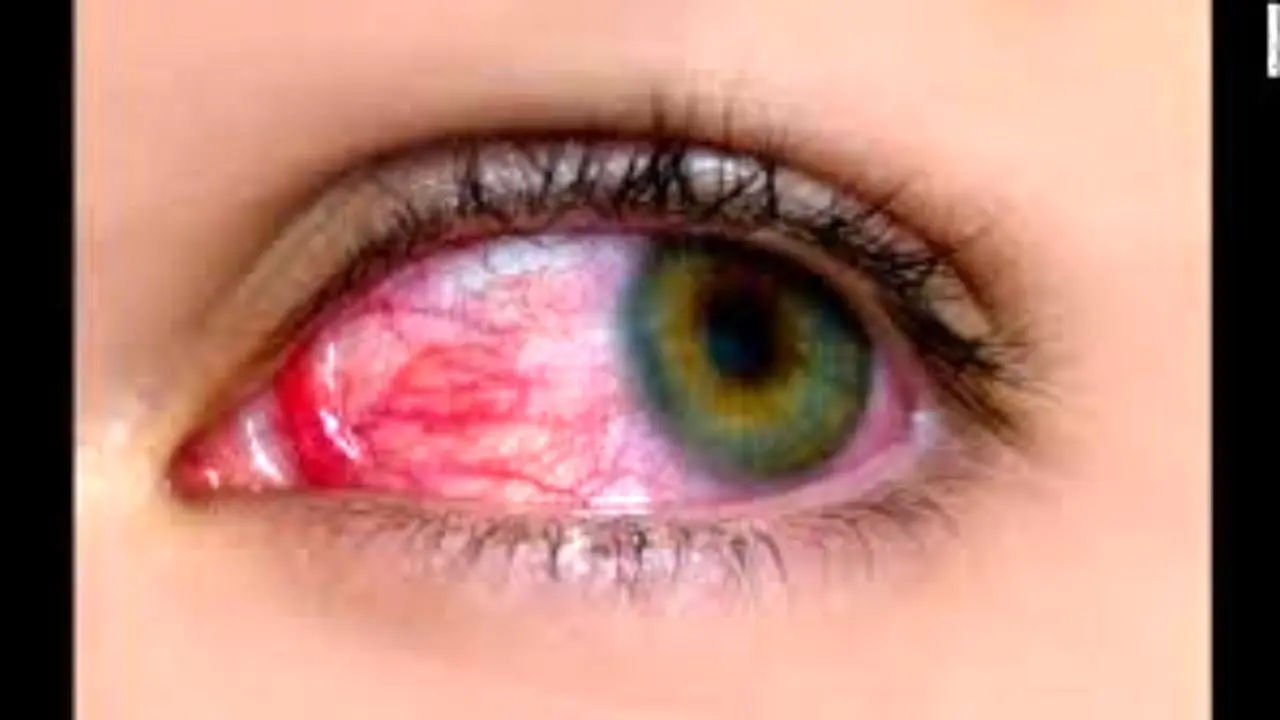 بیماری های چشمی را جدی بگیریم