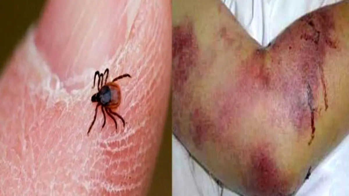 تب کریمه کنگو در کمین کردستانی‌ها