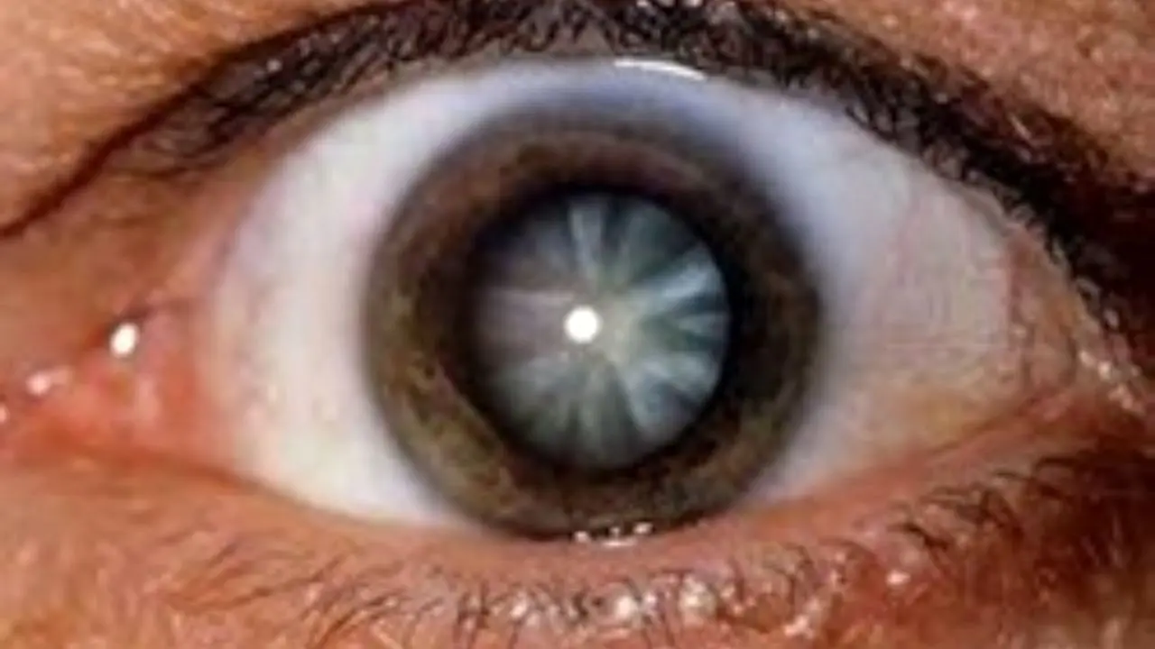 تغییرات مکرر نمره چشم نشانه چه بیماری است؟