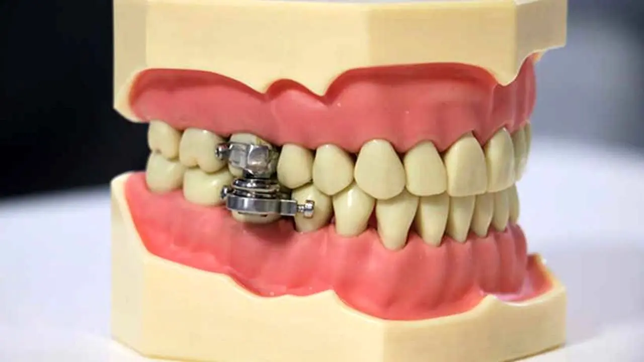 دور دنیا| قفل دندان روش جدیدی برای کاهش وزن