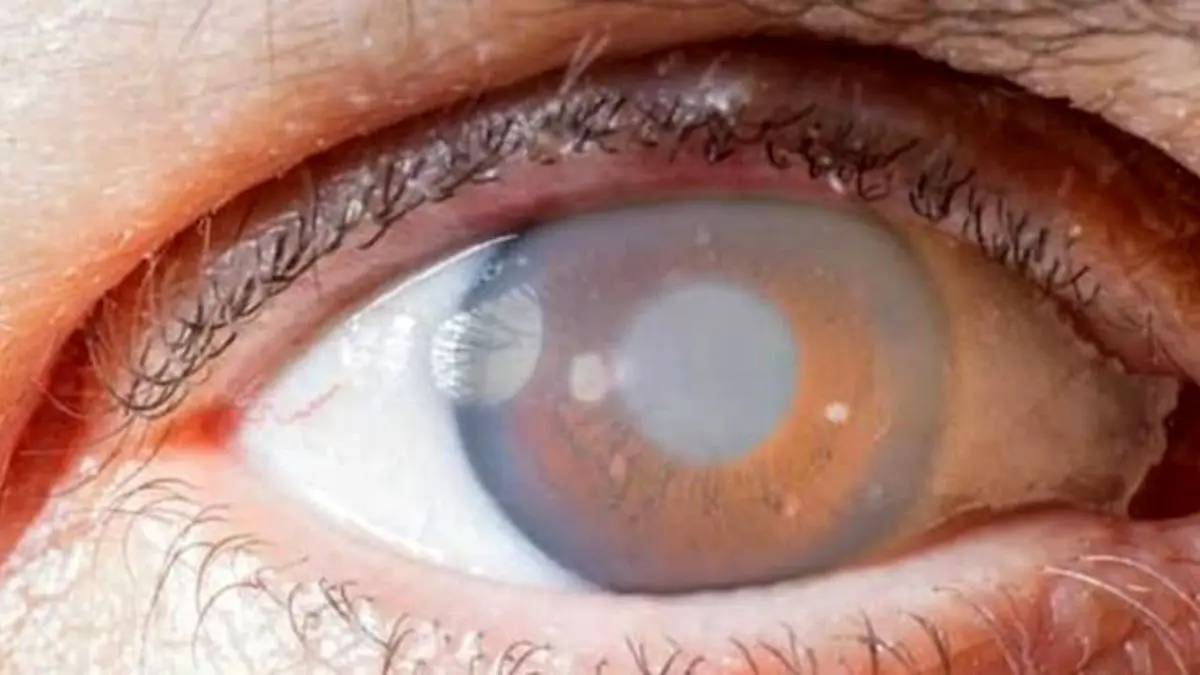 منظور از «تست چشمی» کرونا چیست؟