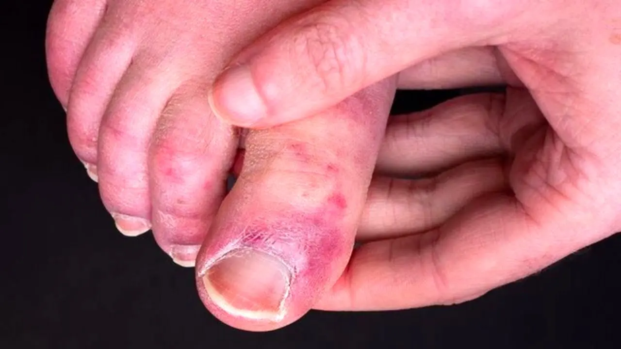 چرا برخی افراد به عارضه "انگشت پای کوویدی" مبتلا می شوند؟