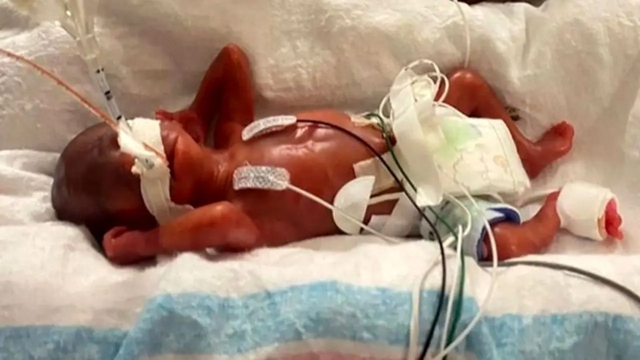 زودرس‌ترین نوزاد جهان؛ پسری که 19 هفته زود به دنیا آمد