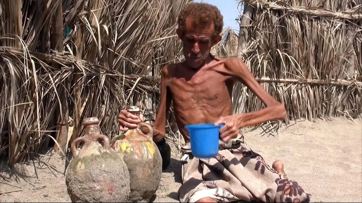 بحران کمبود شدید مواد دارویی در یمن