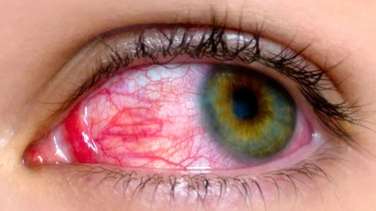 شیوع ویروس چشمی در کشور/ دست دادن و روبوسی می‌تواند باعث سرایت این بیماری چشمی شود
