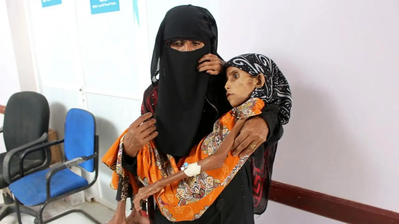 بحران سوء‌تغذیه شدید زنان باردار در یمن
