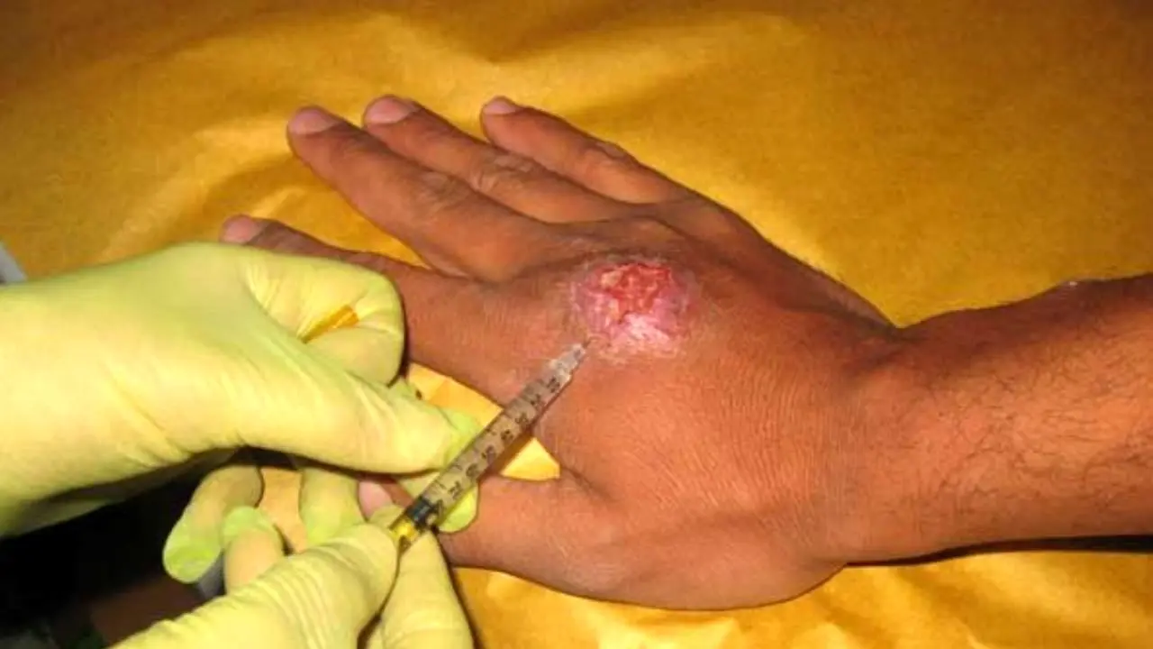 هشدار وزارت بهداشت در رابطه با شیوع بیماری سالک در مناطق سیل‌زده