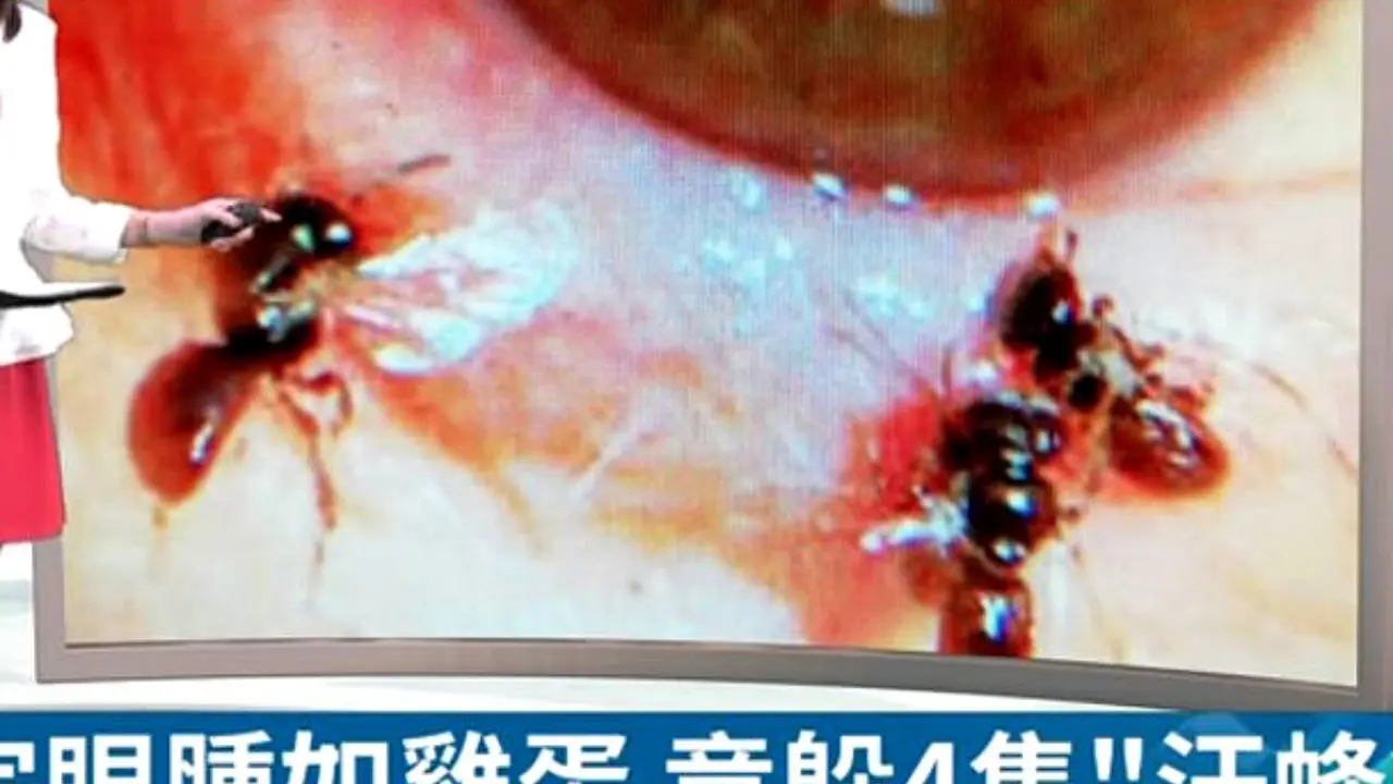 کشف چهار زنبور زنده زیر پلک یک زن تایوانی