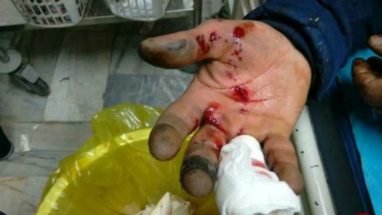 قطع انگشت یک کودک به خاطر انفجار در تهران