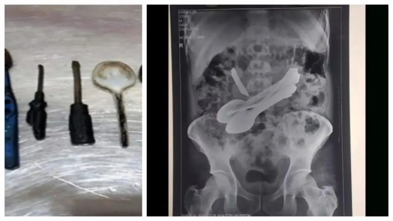 خارج کردن قاشق، چاقو و پیچ‌گوشتی از شکم یک بیمار 35 ساله هندی
