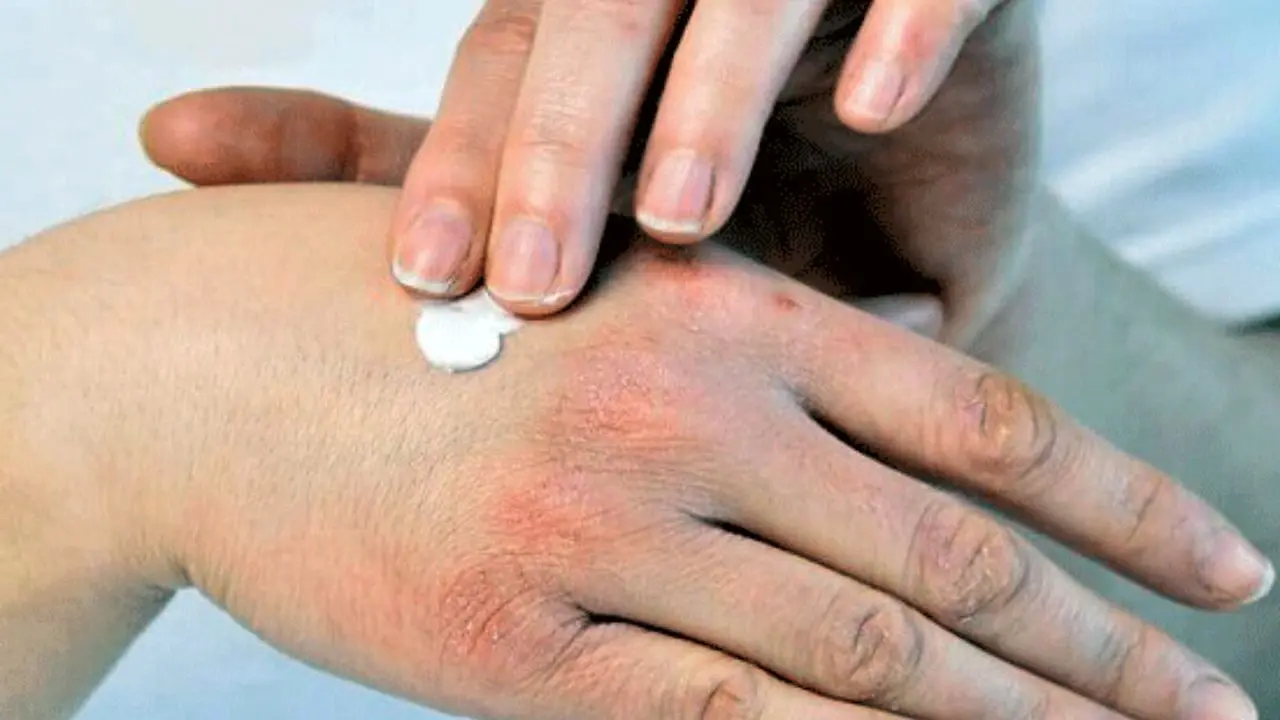 راهکارهای مقابله با خشکی پوست دست در روزهای کرونایی چیست؟