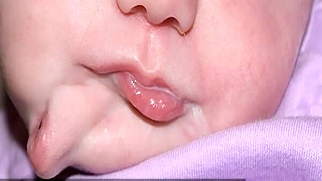 نوزادی با دو دهان متولد شد