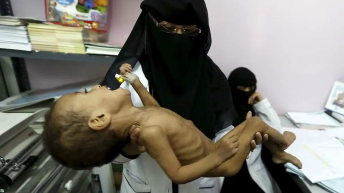 تعداد کودکان یمنی در معرض سوء تغذیه به 2.4 میلیون نفر می‌رسد