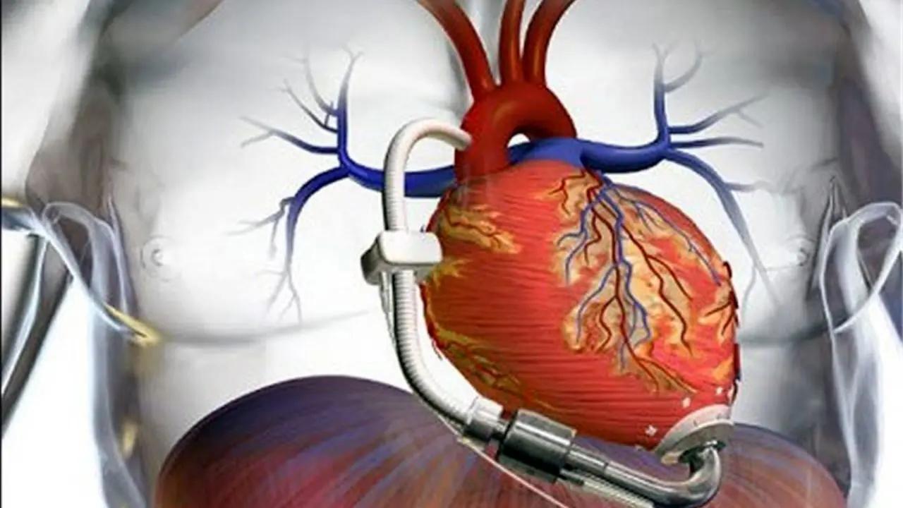 سندرم قلب شکسته در دوران همه‌گیری کرونا افزایش یافته است