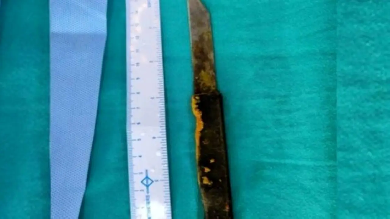 دور دنیا| خروج چاقوی 20 سانتی از کبد مرد هندی جراحان را شگفت‌زده کرد+ عکس
