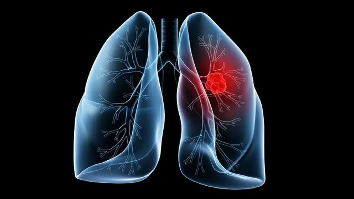 چگونه سرطان ریه و ابتلا به کرونا را از یکدیگر تشخیص دهیم؟