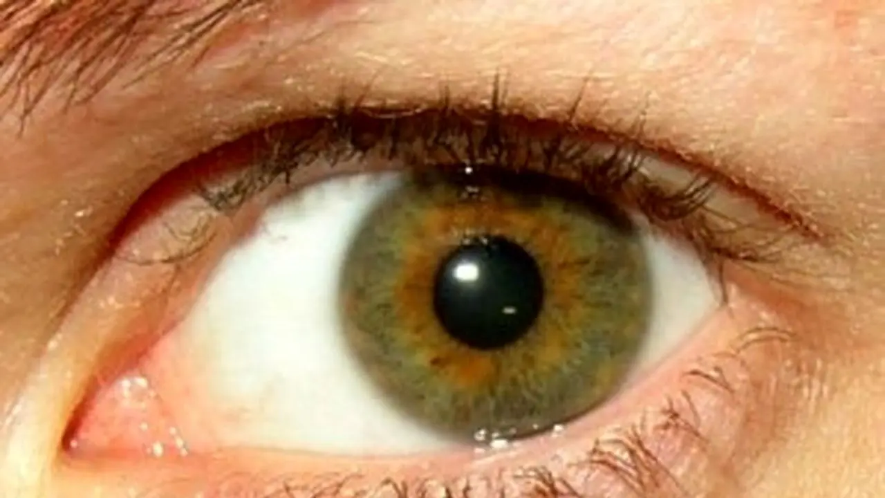 امکان التهاب چشم در تهاجم کووید 19 وجود دارد