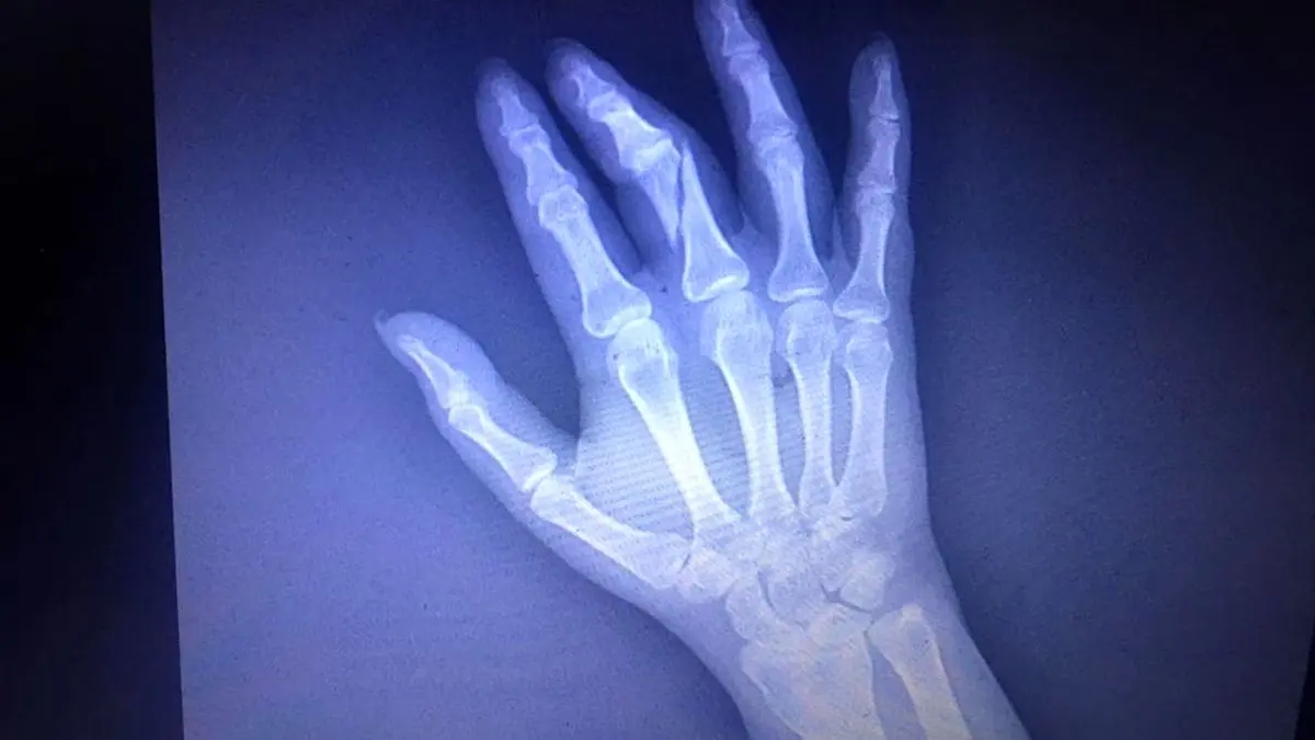 مأمور حراست انگشتان دست خبرنگار را شکست + عکس