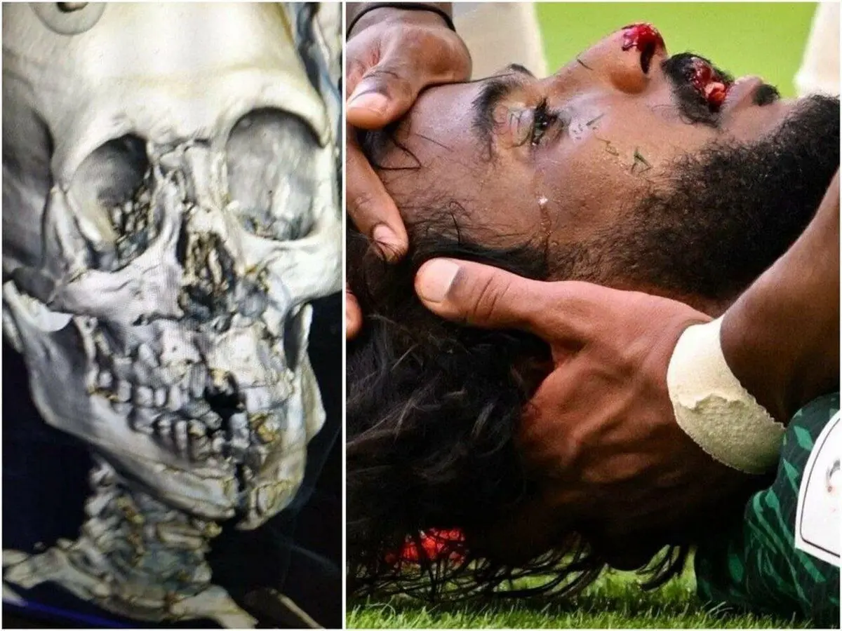تصویر دردناک از جمجمه شکسته مدافع عربستان