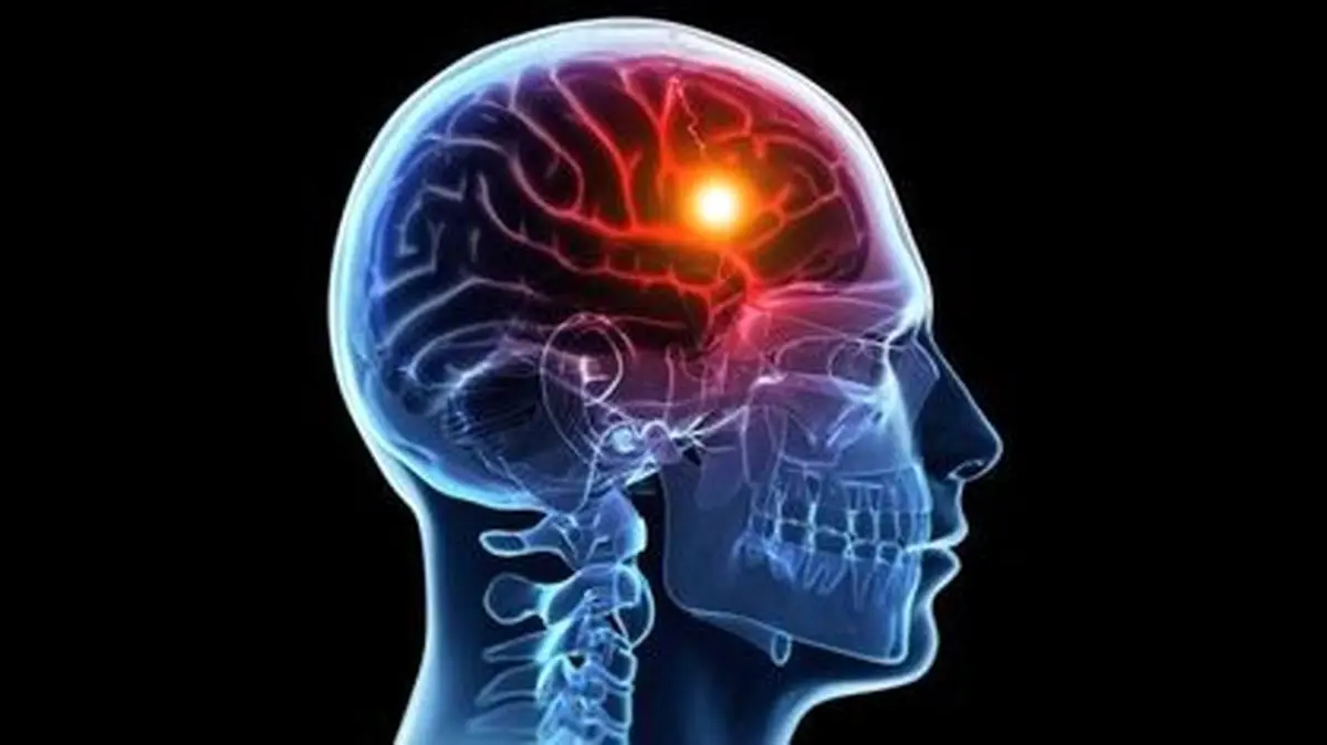 شایع‌ترین عوامل بروز سکته مغزی کدامند؟