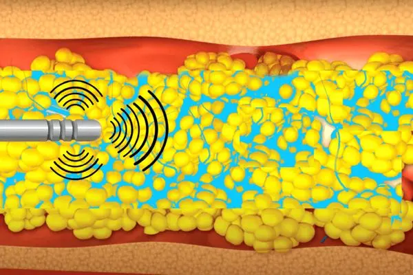 جدیدترین روش تخلیه چربی شکم کدام است؟
