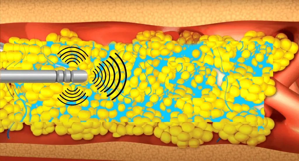 چربي،شكم،تخليه،كاهش،ليپوساكشن،جراح،پوست،نوين،بدن،طبيعي،نتيجه ...